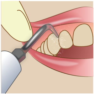 腫れ 膿 歯茎